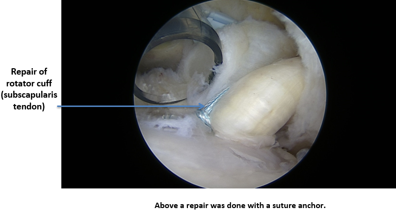 2016-04APR08_TRO_Rotator Cuff Tear 4