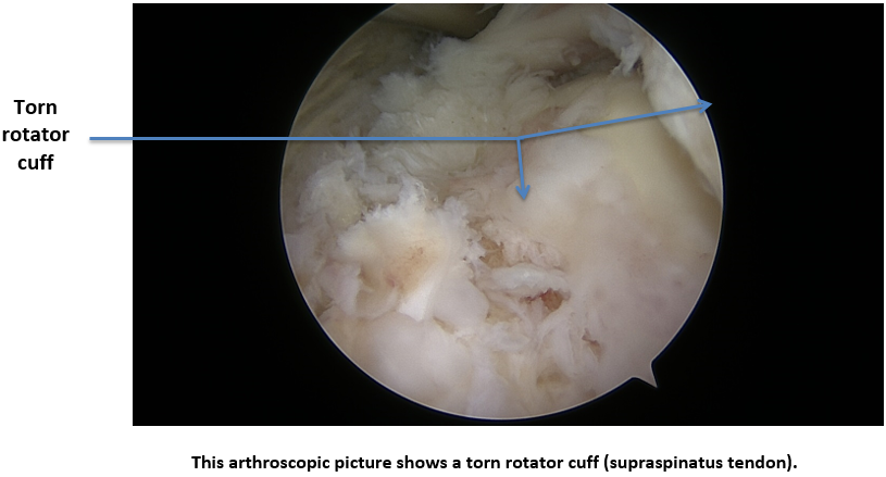 2016-04APR08_TRO_Rotator Cuff Tear 5