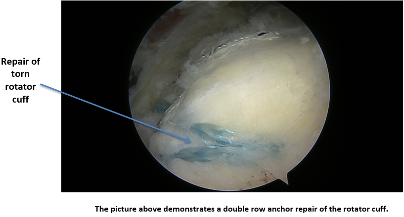 2016-04APR08_TRO_Rotator Cuff Tear 6