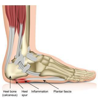 Featured image for “What is plantar fasciitis?”